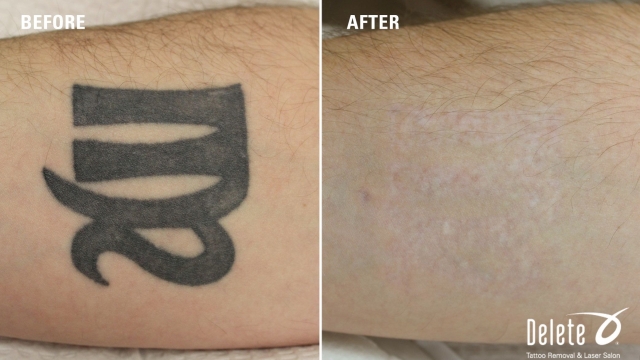 Tattoo Removal And Cover-Up