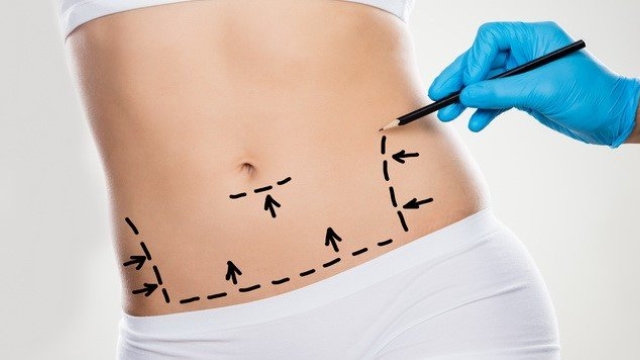 Flaunt your Flawless Figure: The Ultimate Guide to Abdominoplasty