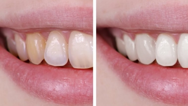 12 Tips for a Dazzling White Smile: Unveiling the Secrets of Teeth Whitening