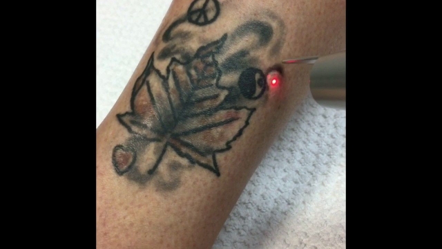 Tattoo Removal Made Easy With Hair Laser Removal